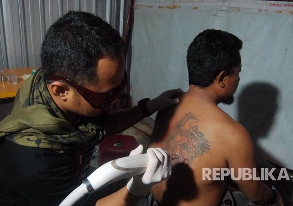 2.700 Orang Ikuti Program Hapus Tato di Islamic Medical Service